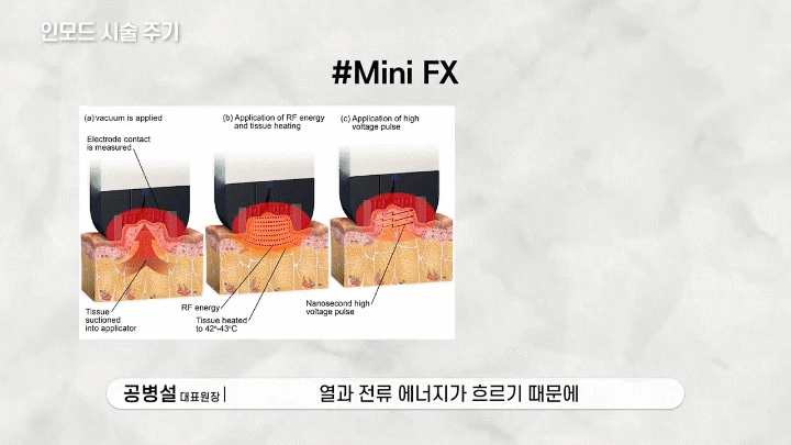 춘천피부과 인모드 얼굴선과 탄력 고민이 함께 있을 때 확인할 부분