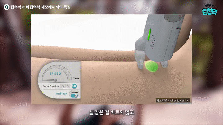 춘천피부과 젠틀맥스 레이저제모